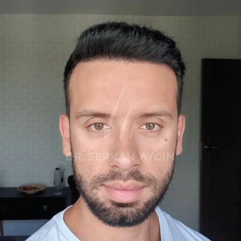 Hair transplantation before after result 4100 grafts