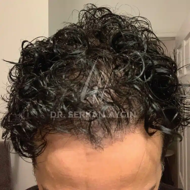 Hair transplantation after 4200 grafts