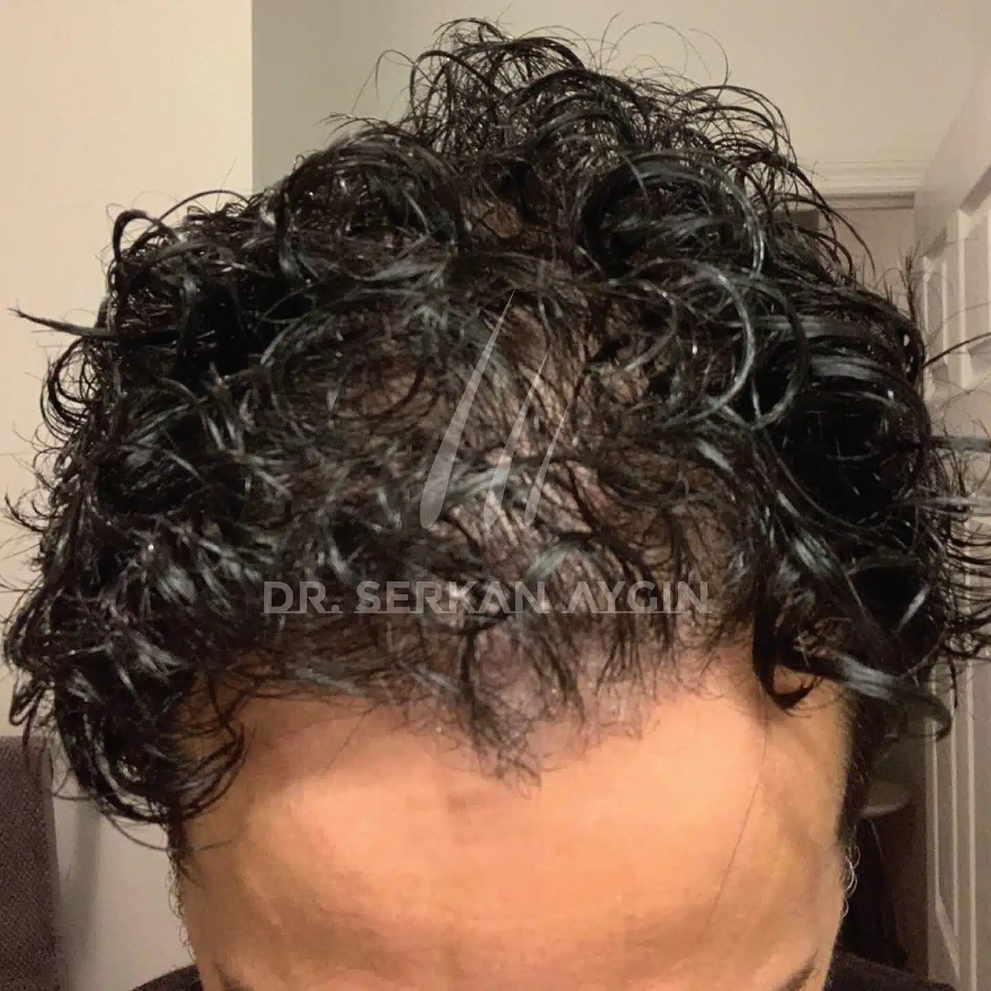 Curly hair thinning on top outlet
