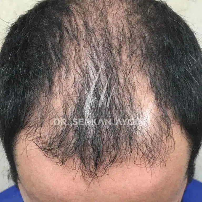 Hair transplantation before 4200 grafts
