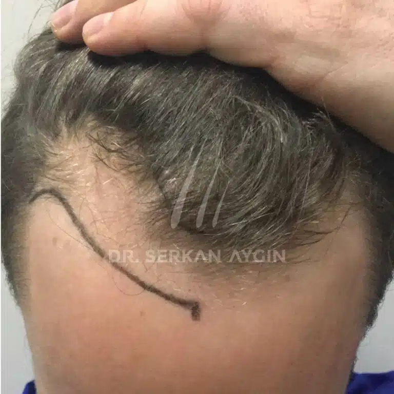 Hair transplantation receding hairline before and after