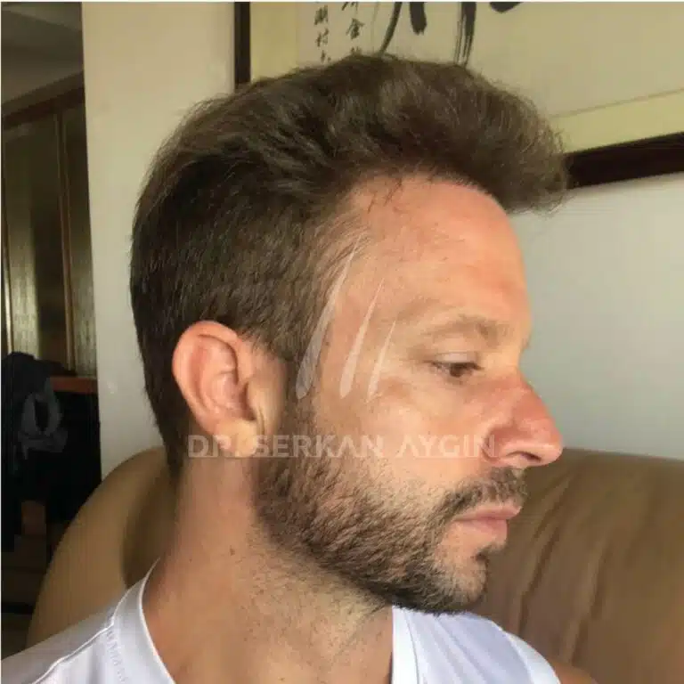 Hair transplantation receding hairline before and after result