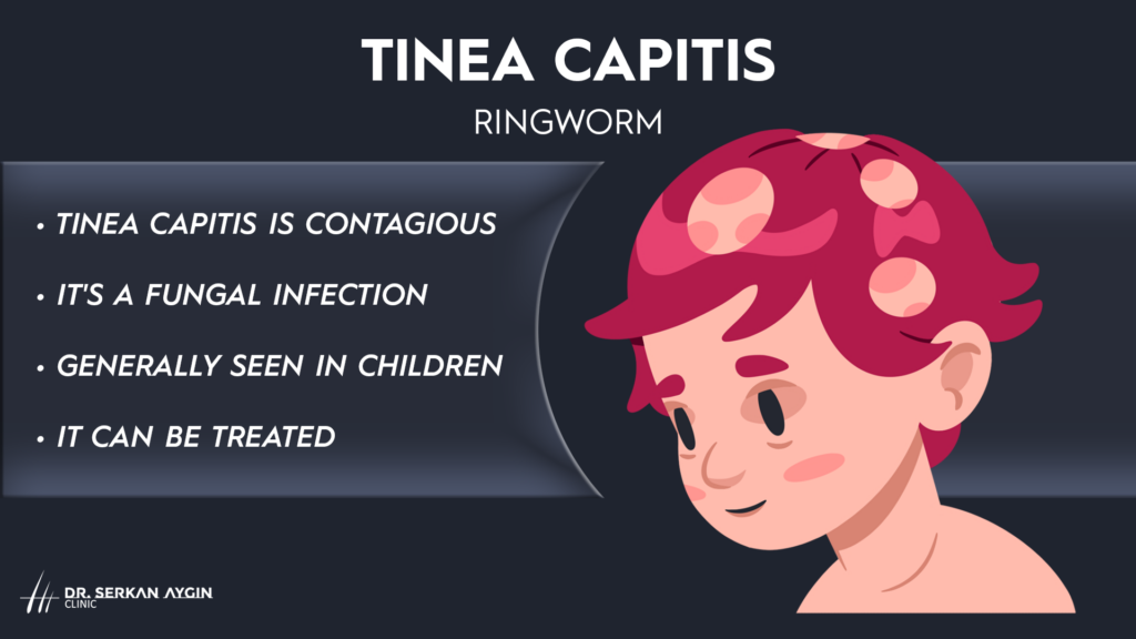 tine capitis ringworm