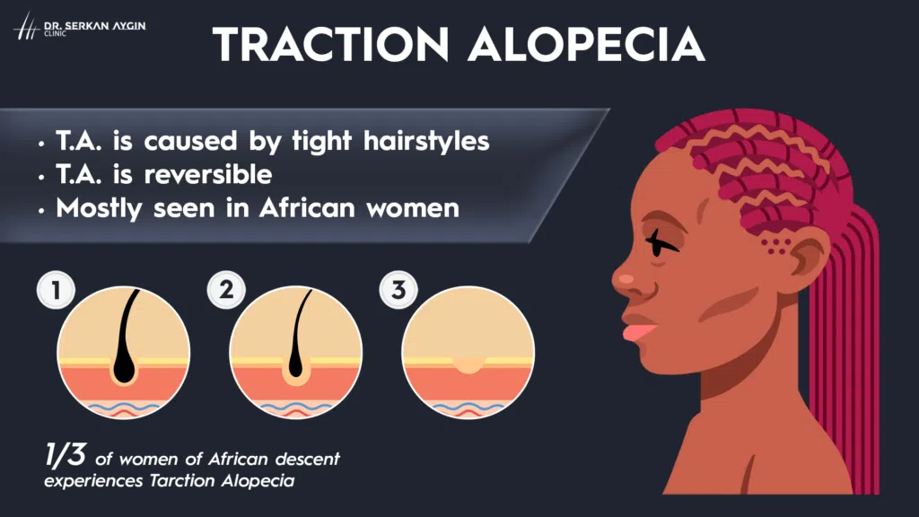 traction alopecia