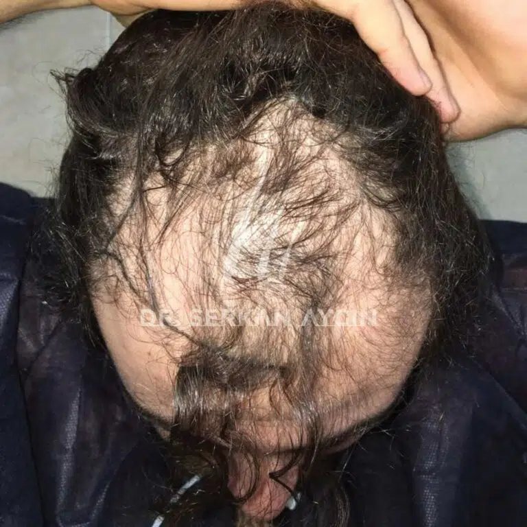 Turkey hair transplant before after 4000 grafts