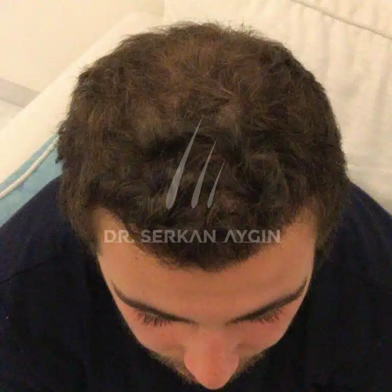 Turkey hair transplant success with 4000 grafts