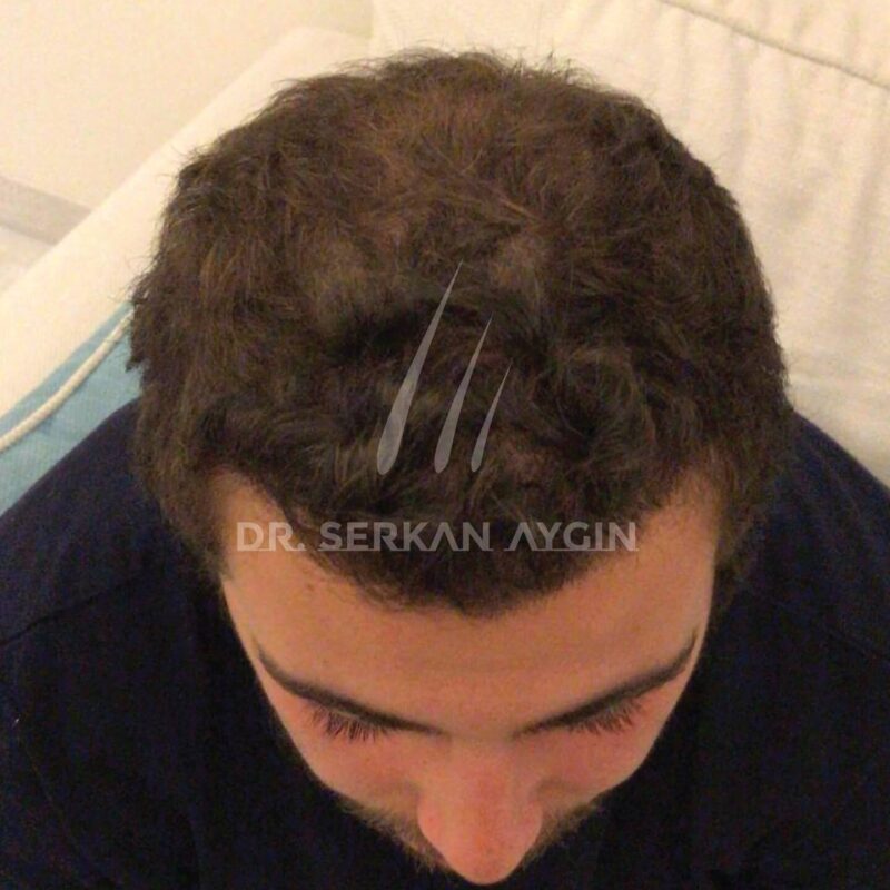 Turkey hair transplant success with 4000 grafts