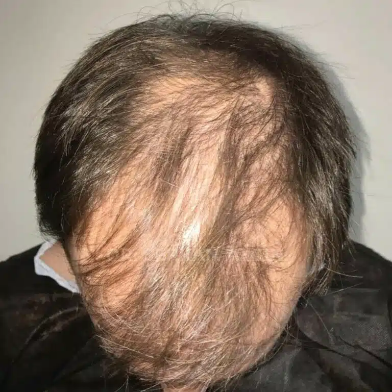 Vor der Haartransplantation - 4000 Grafts