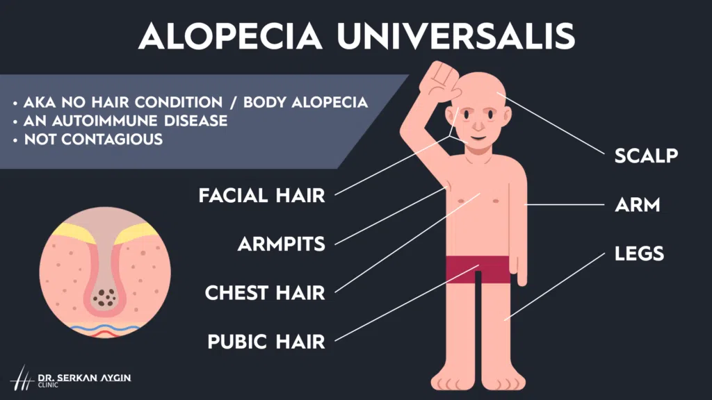 body alopecia