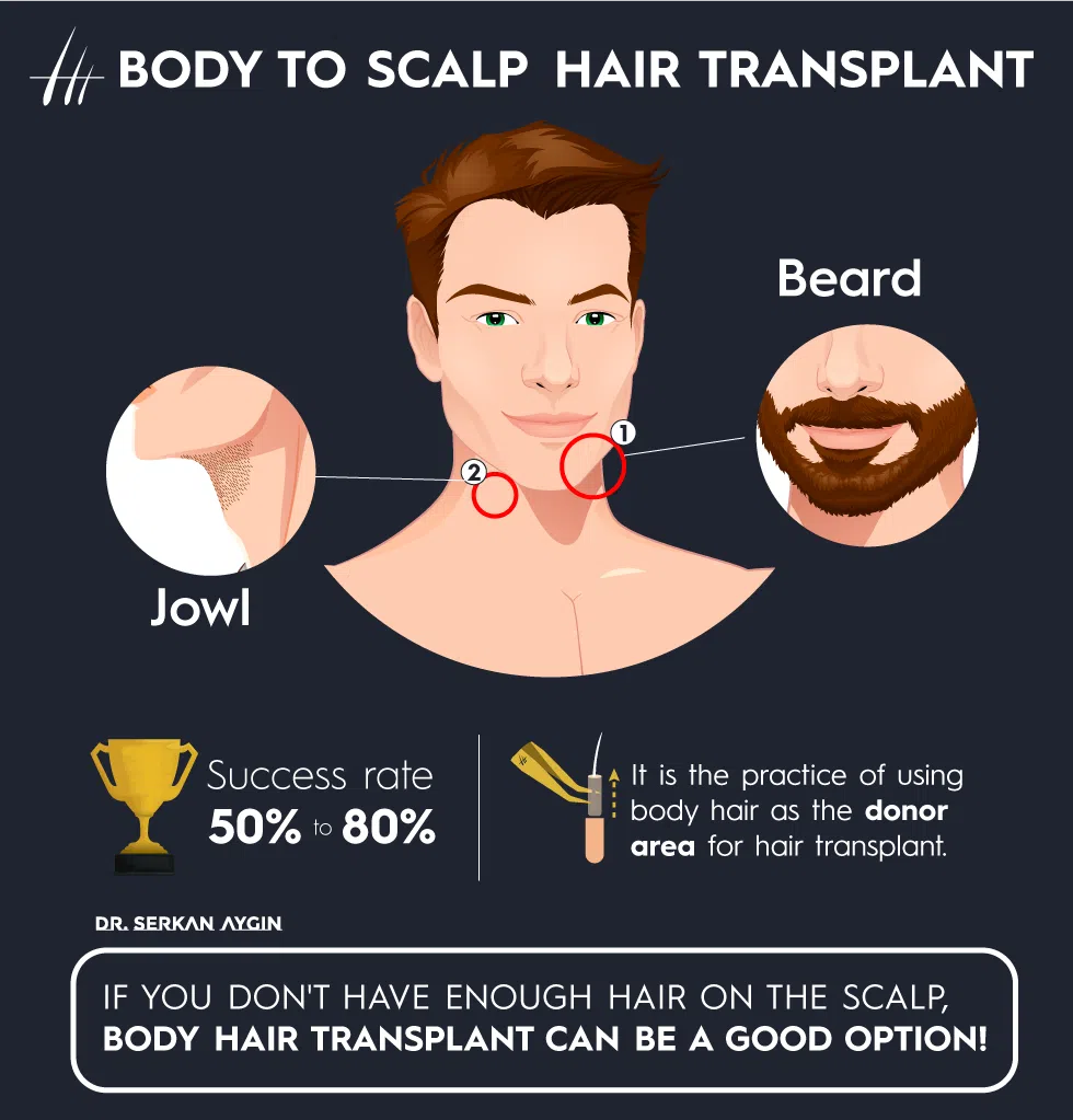 body hair transplant, body to hair transplant, dr serkan aygin body hair transplant