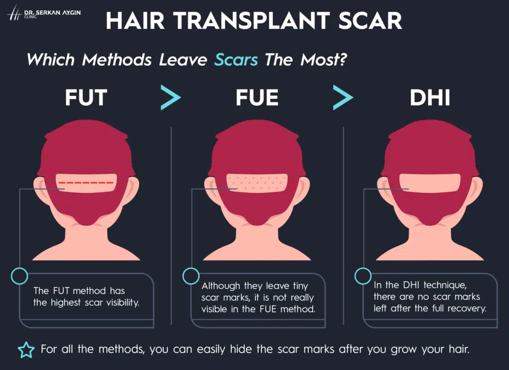 hair transplant scar, fue scars, fut scars, dhi scar, hair transplant scars, hair transplant postop, scar after hair transplant