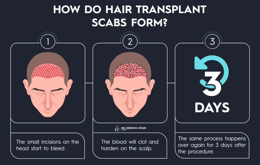 scabs after hair transplant, how do scars form, scab formation after hair transplant, scab picture, hair transplant scabs