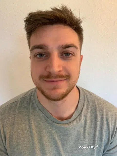 12 months after hair transplant shockloss