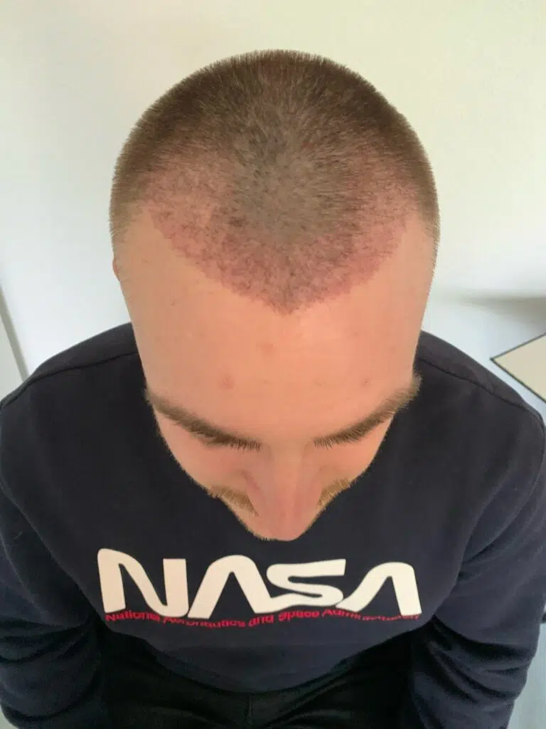 5 Weeks after hair transplant shock loss