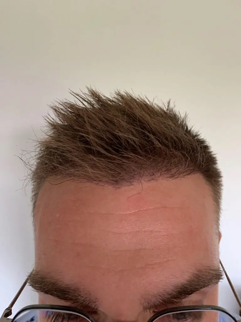 6 months after hair transplant shock loss