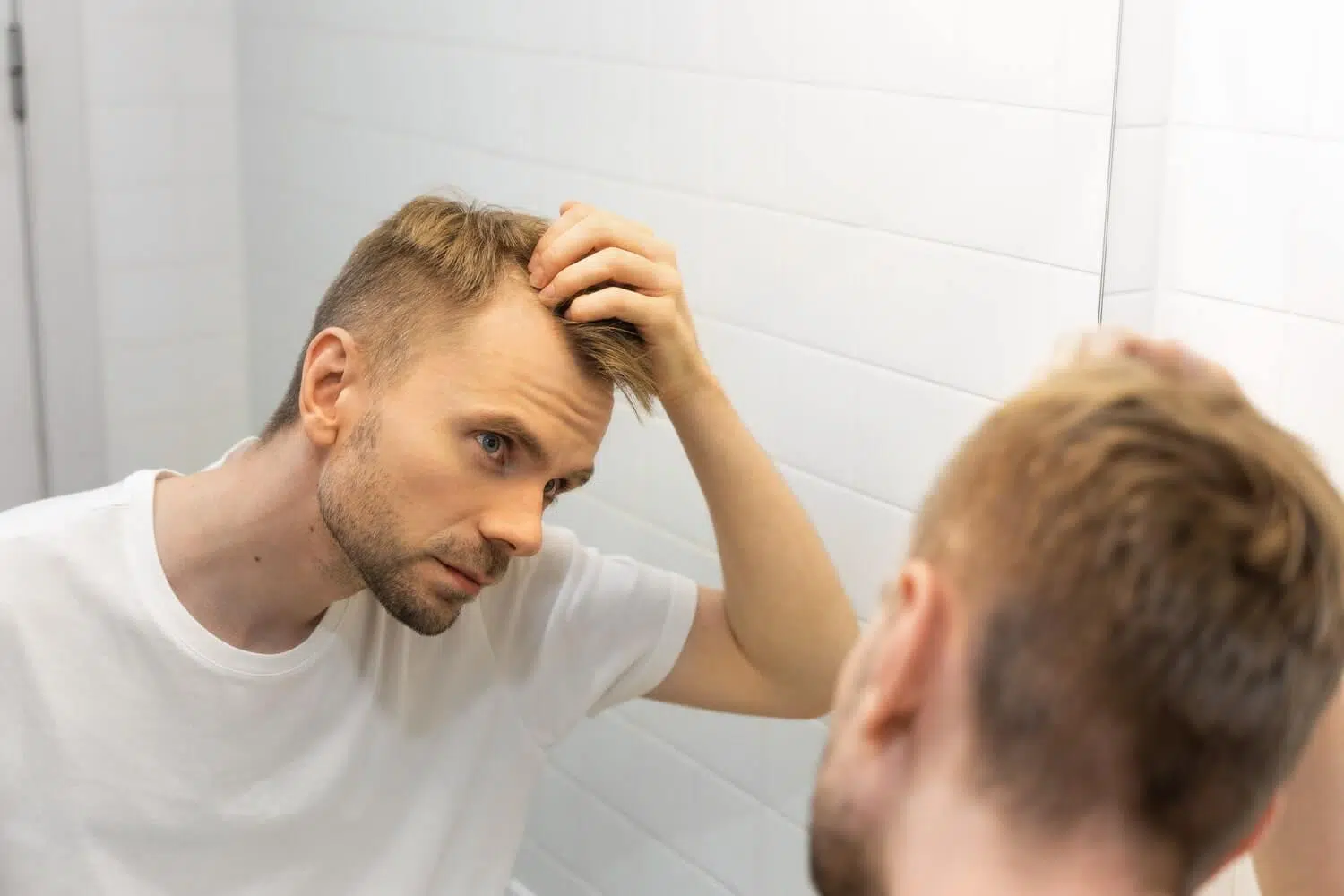 Alopecia androgenetica