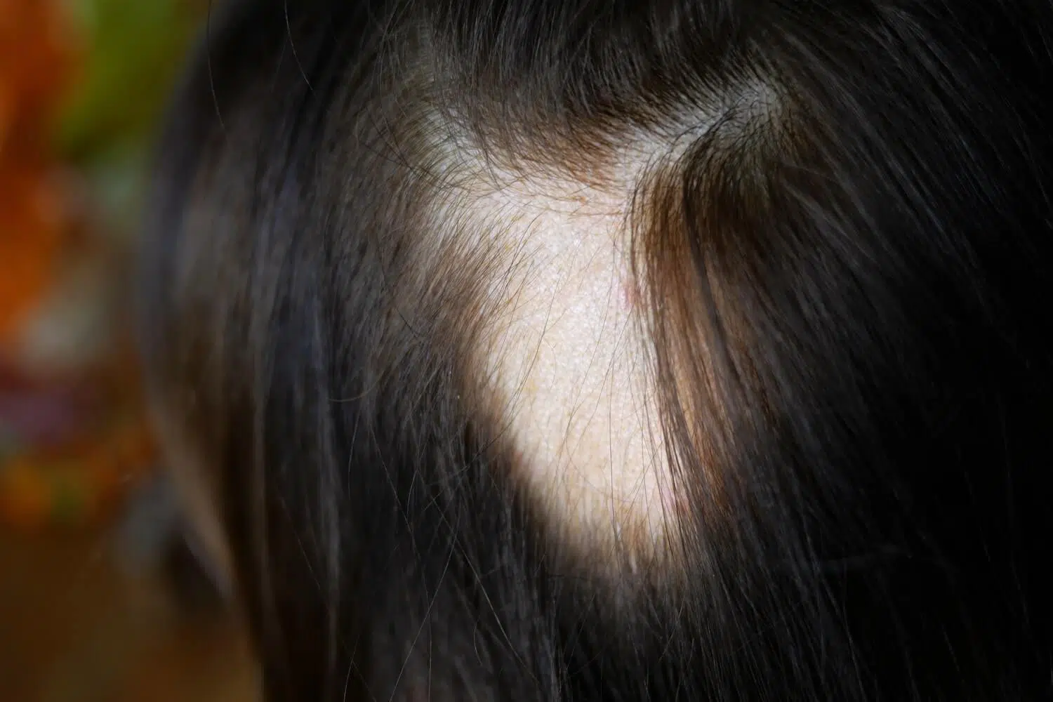 Alopecia areata