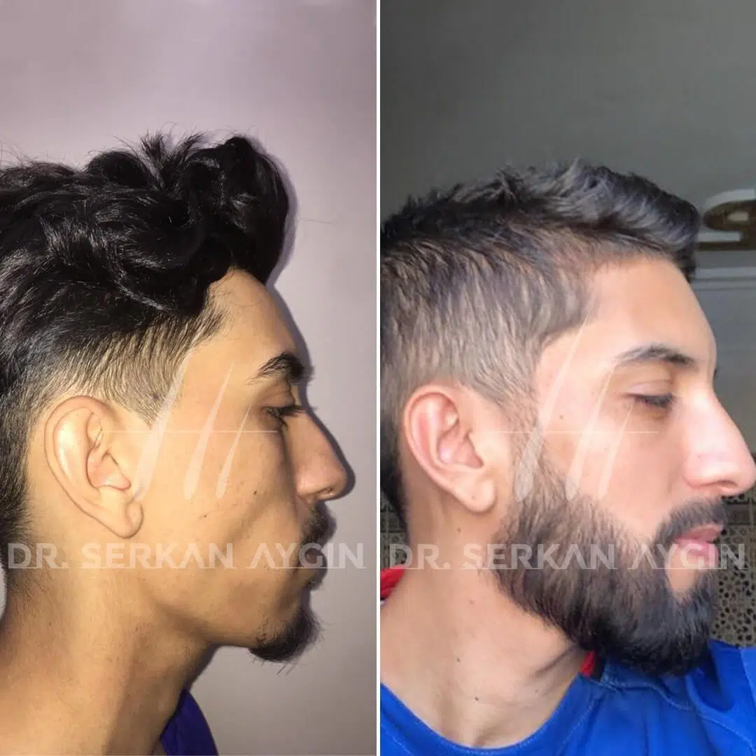 Beard transplant turkey cost before and after