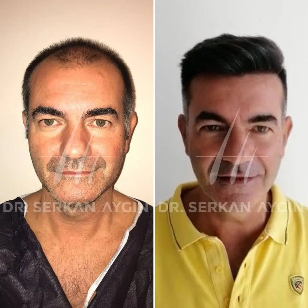 Beste Haartransplantation Türkei