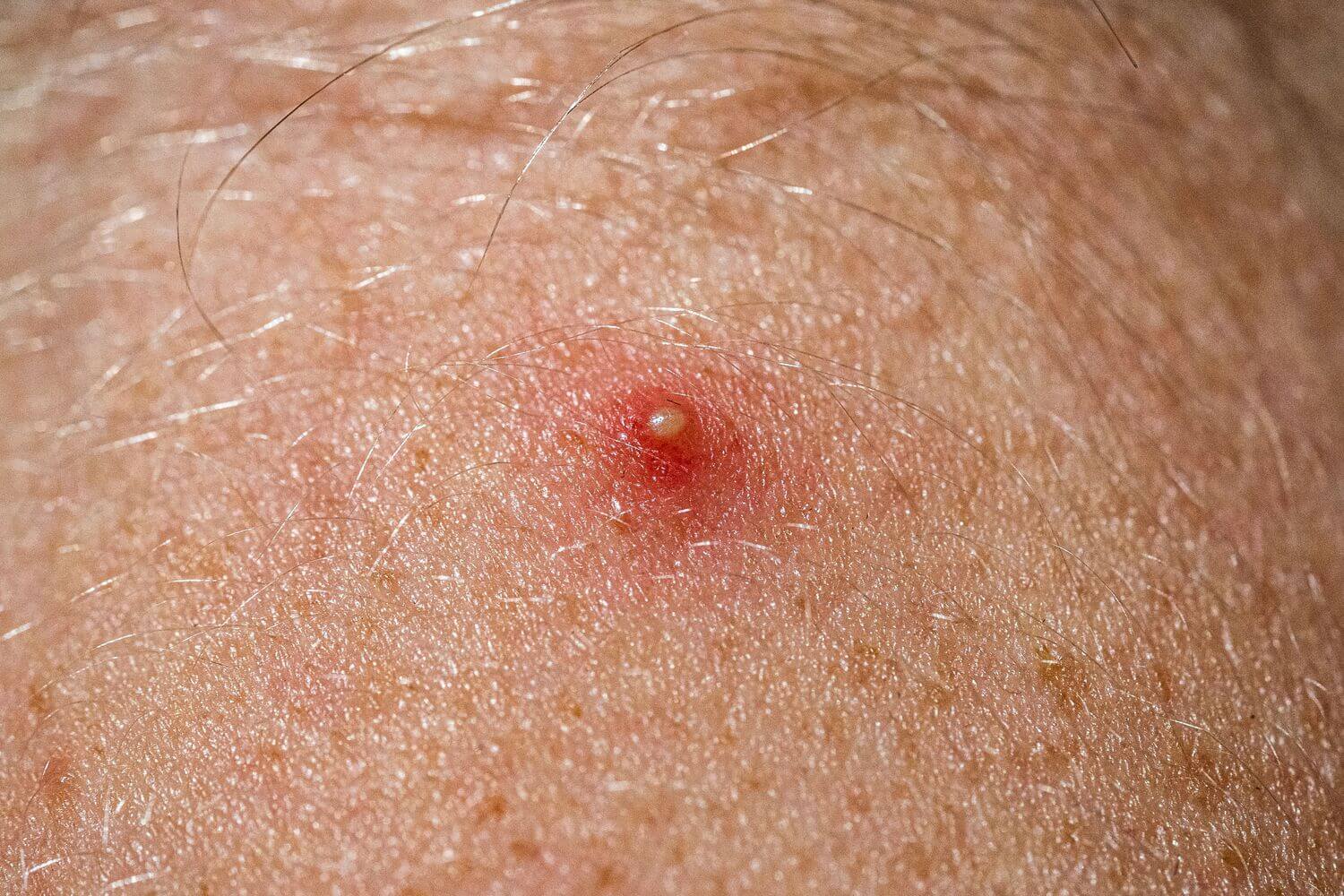 Folliculitis After Hair Transplant