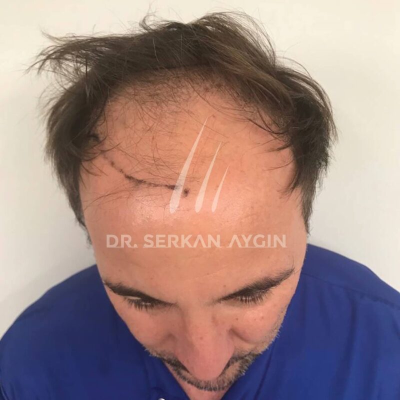 Haarausfall vorher - 3800 Grafts