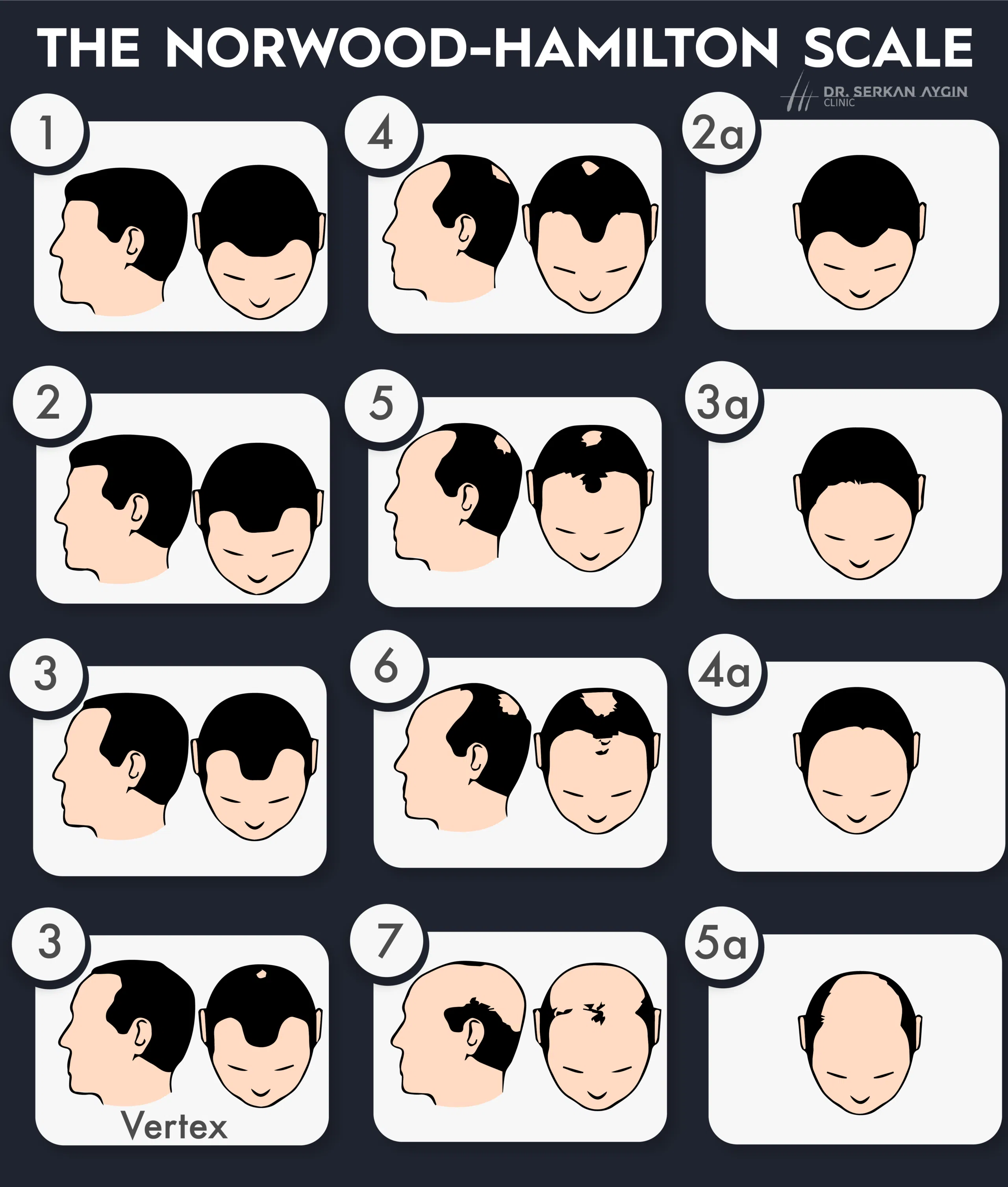 hair loss scale, norwood-hamilton scale, man hair loss stages, male hair loss scale