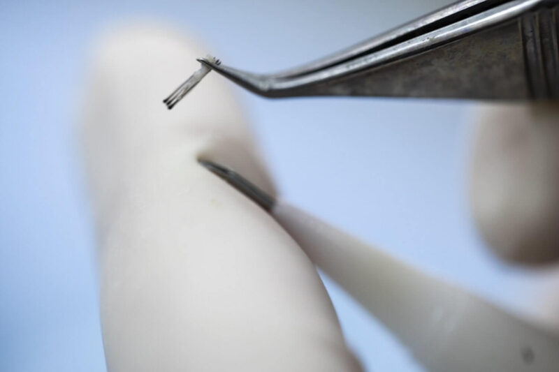 Hair transplant Grafts