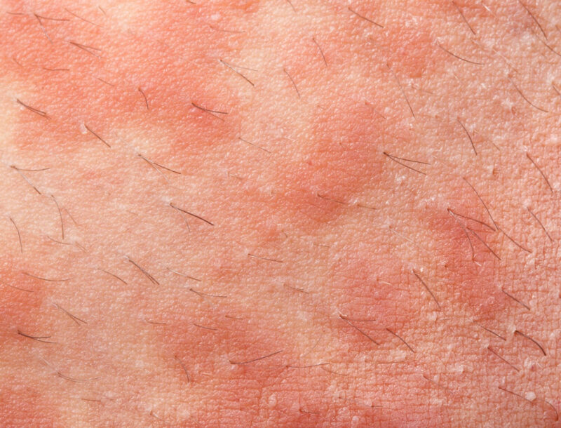 Hair transplant Seborrheic Dermatitis