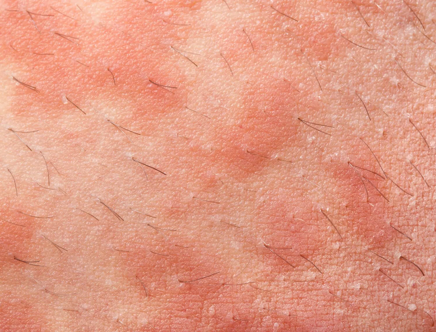 Hair transplant Seborrheic Dermatitis