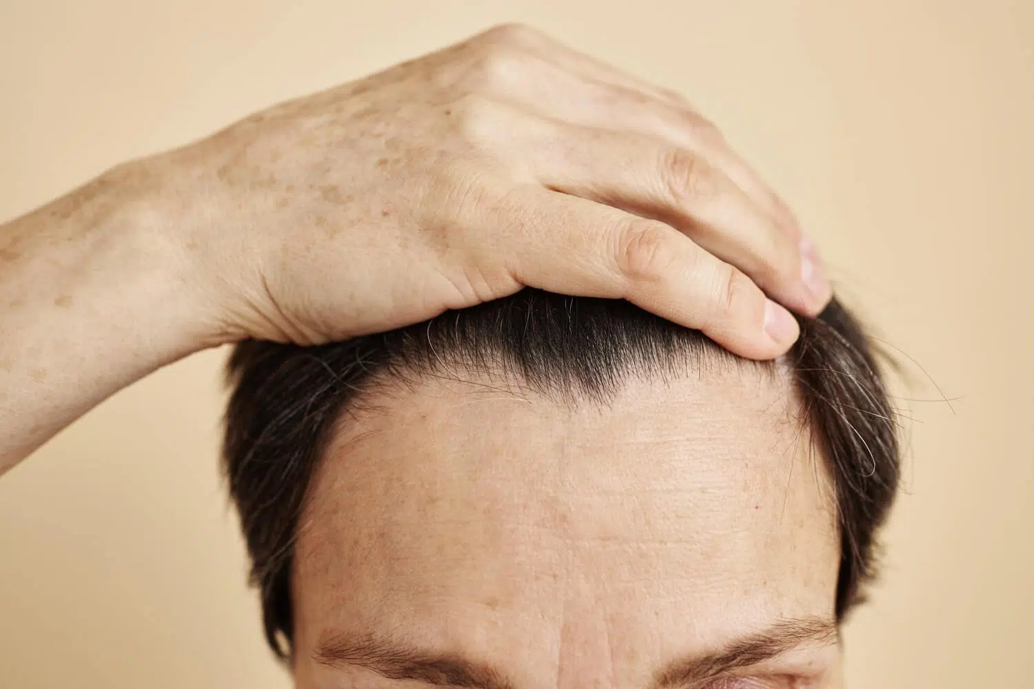 Hairline transplant