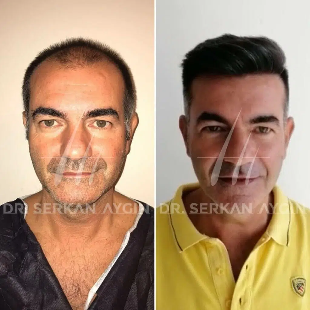 Il miglior trapianto di capelli in Turchia