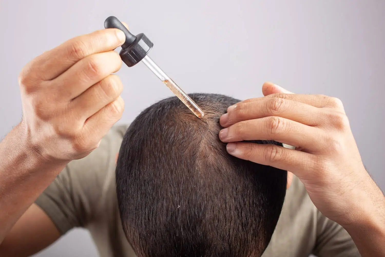 Minoxidil after hair transplant
