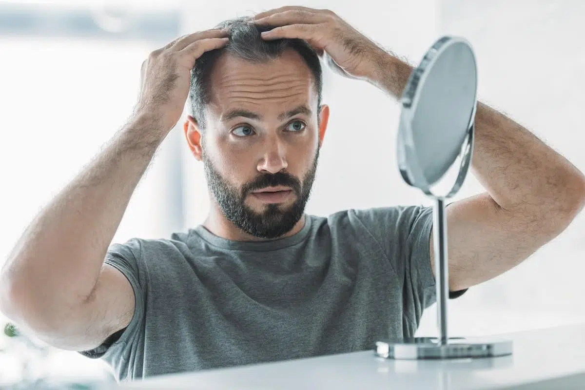 Second hair transplant