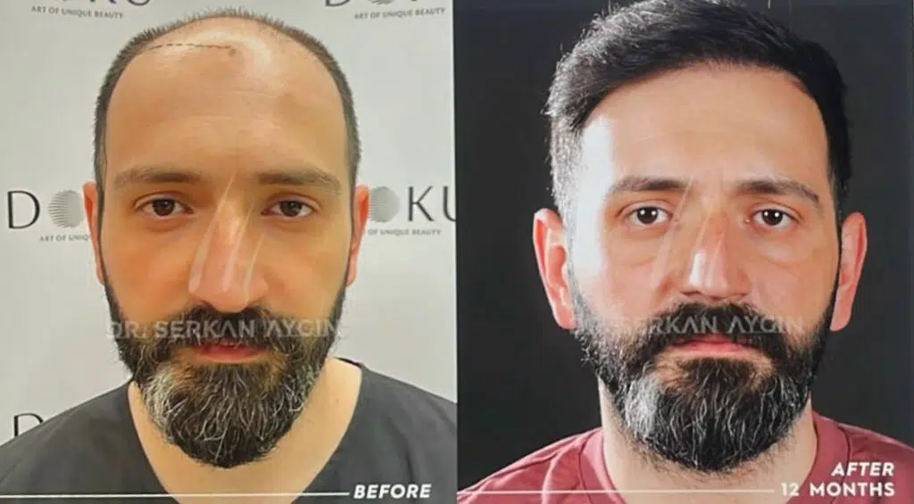 my hair transplant journey