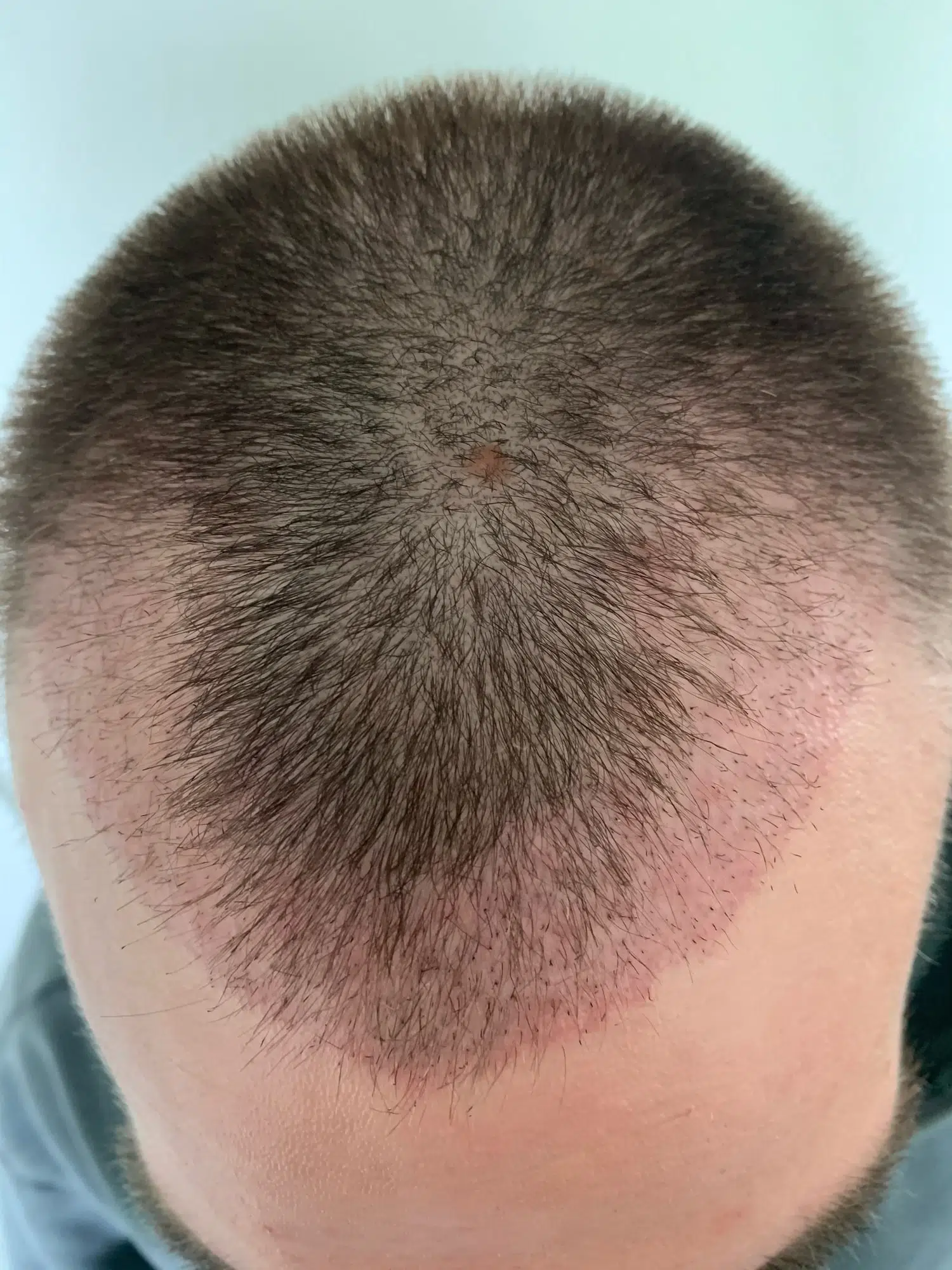 Shock loss after hair transplant