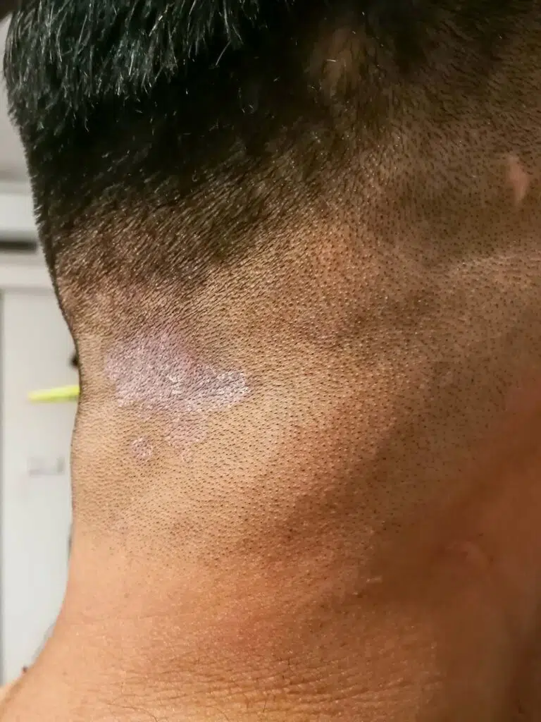 Tinea capitis - Ringelflechte