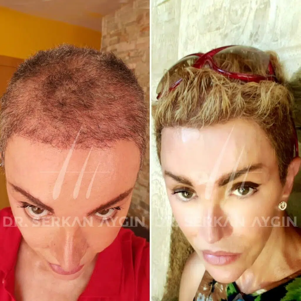 Trapianto di capelli prima dopo donne