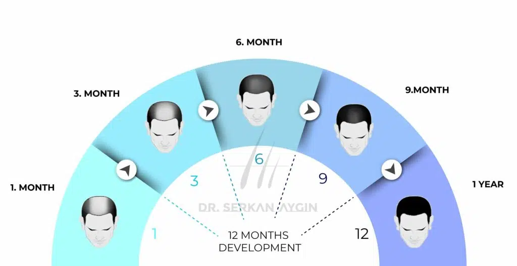 hair transplant timeline