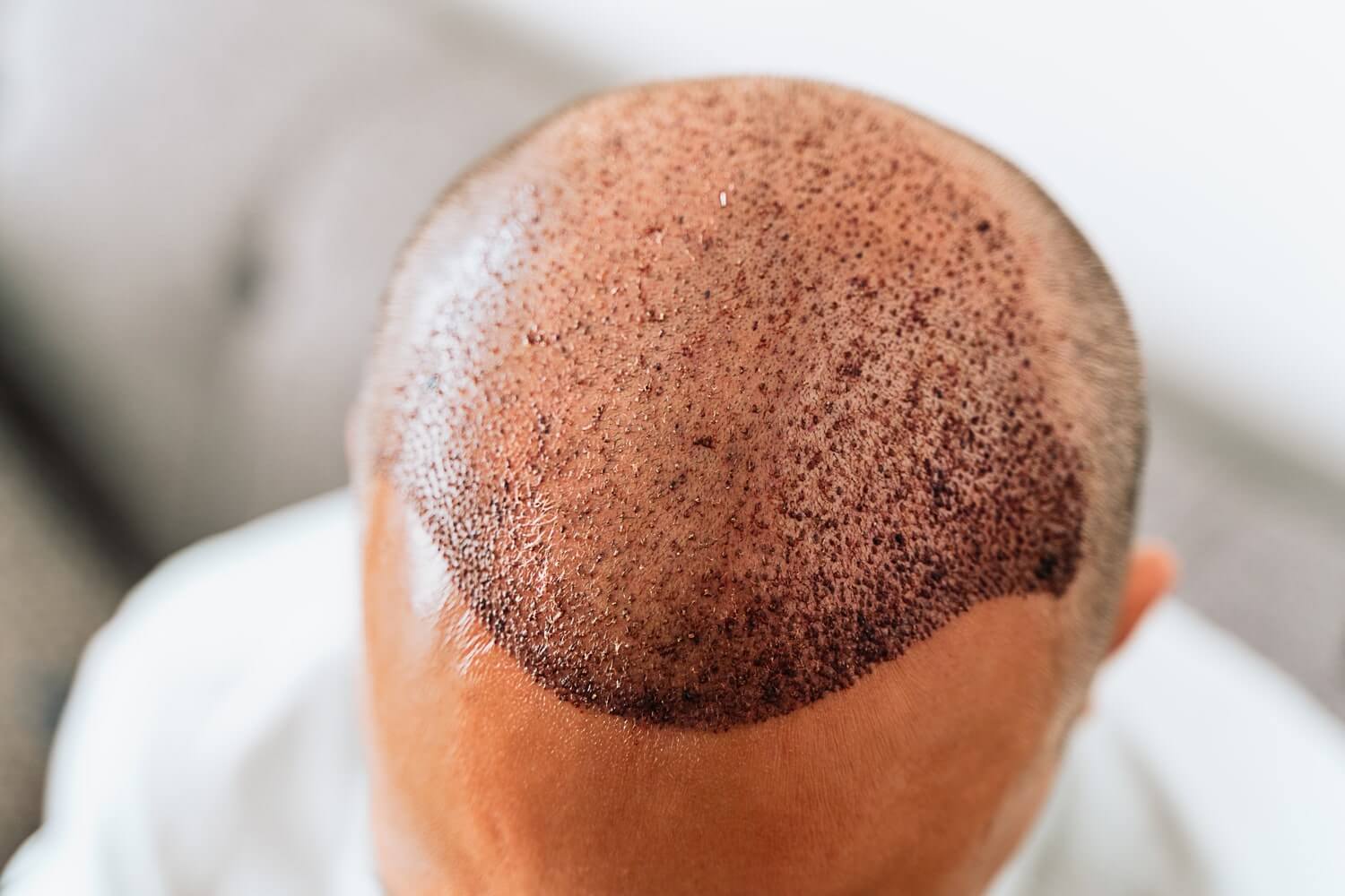 Haartransplantation Krusten