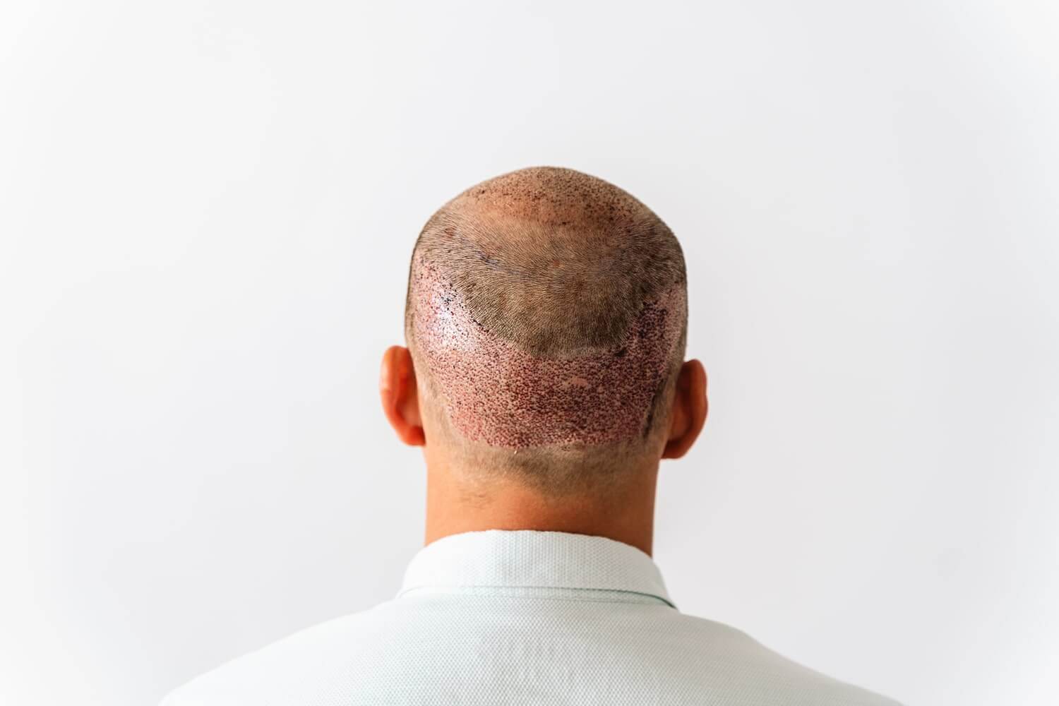 Haartransplantation Narben
