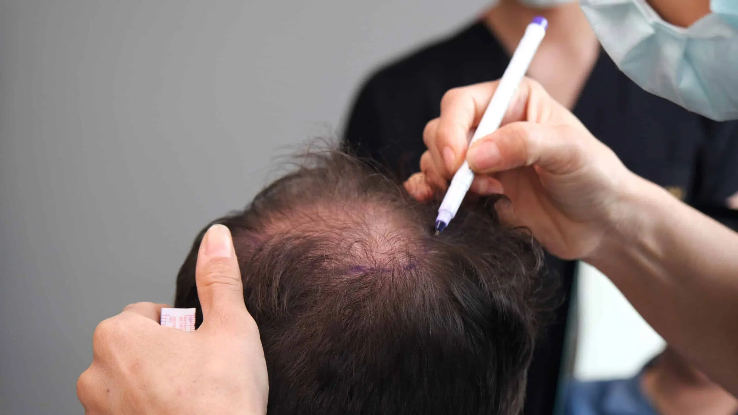 Il trapianto di capelli è fallito
