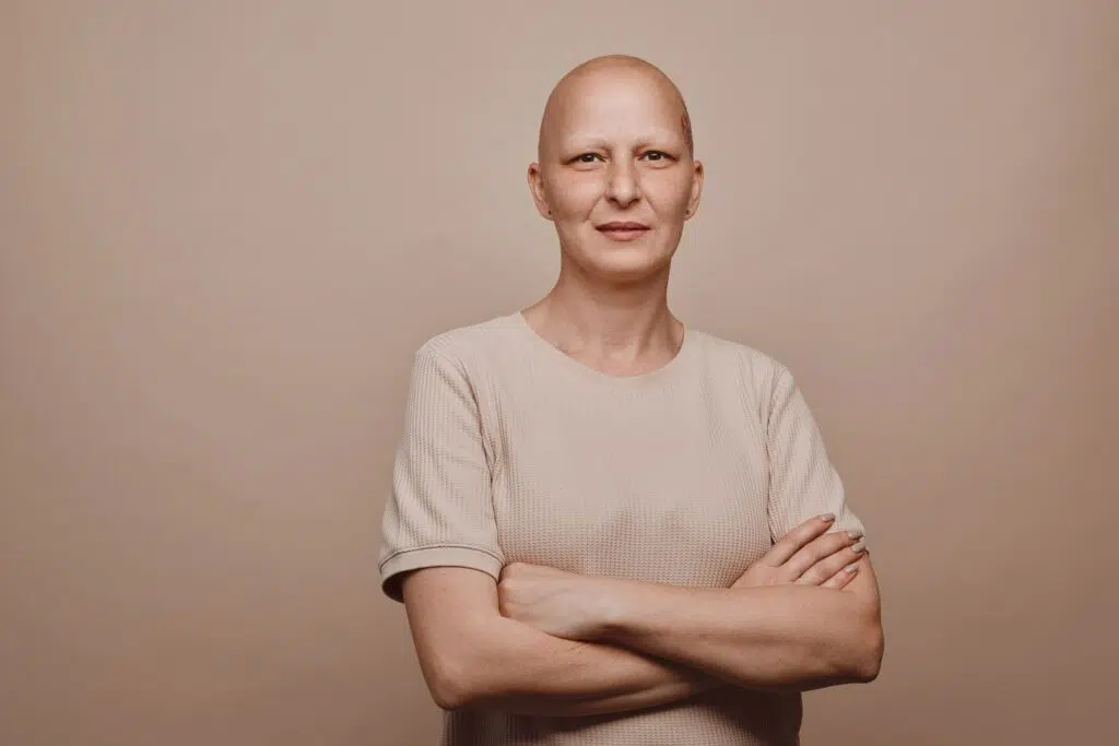 Alopecia totalis