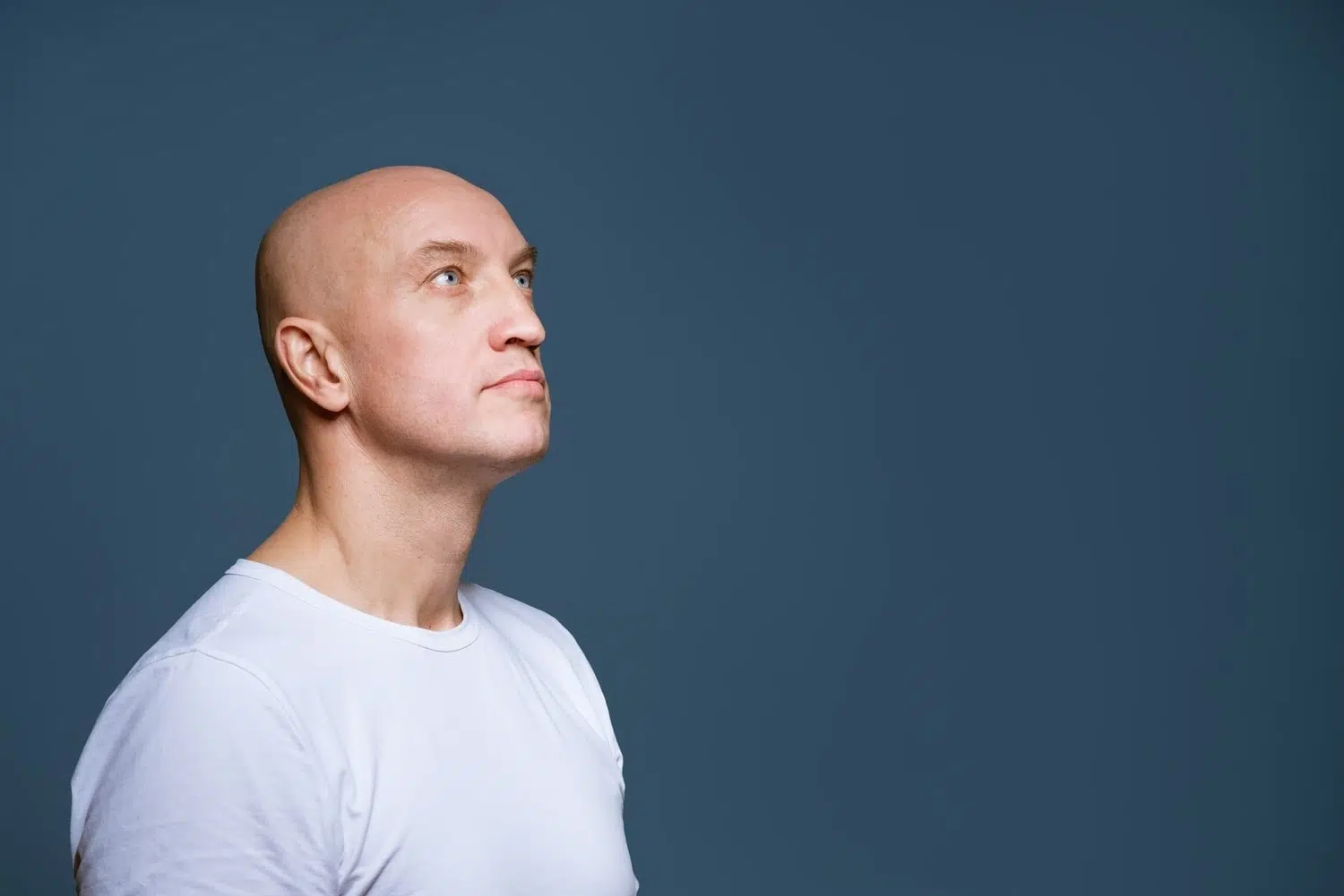 Alopecia universalis