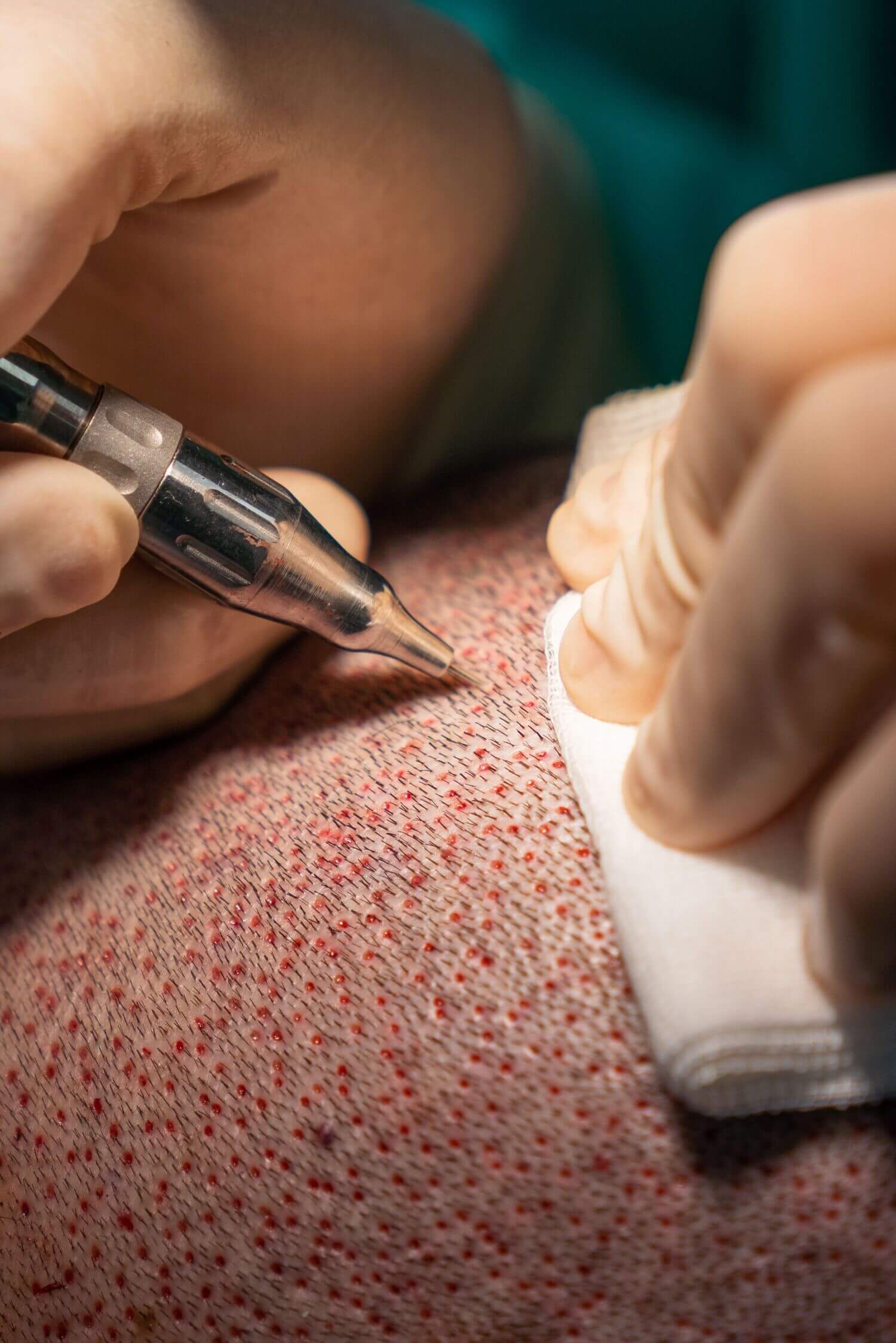 Haartransplantation Infektion
