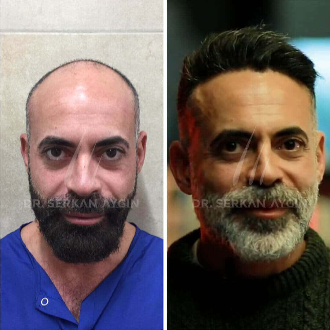 Haartransplantation nach 10 Jahren