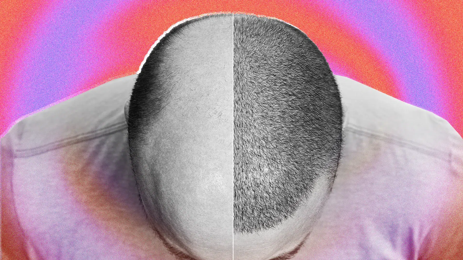 GQ US, What a Hair Transplant Looks Like—Week By Week