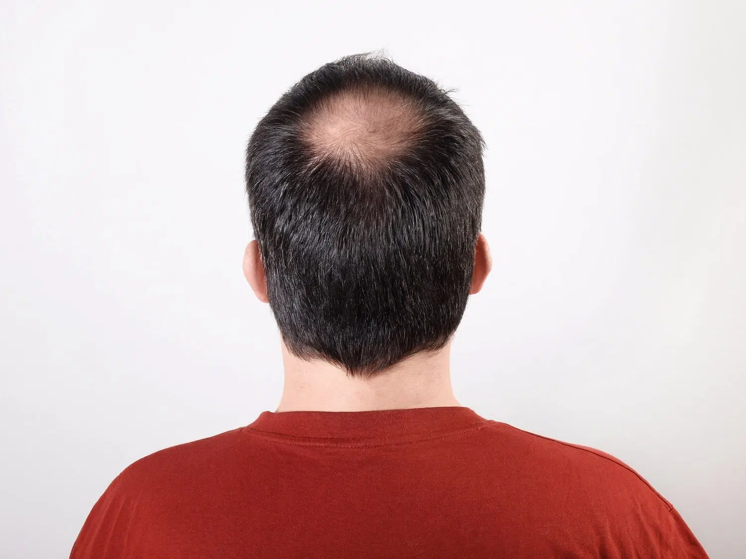 Haartransplantation Tonsur