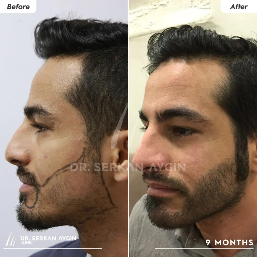beard transplant before and after 2