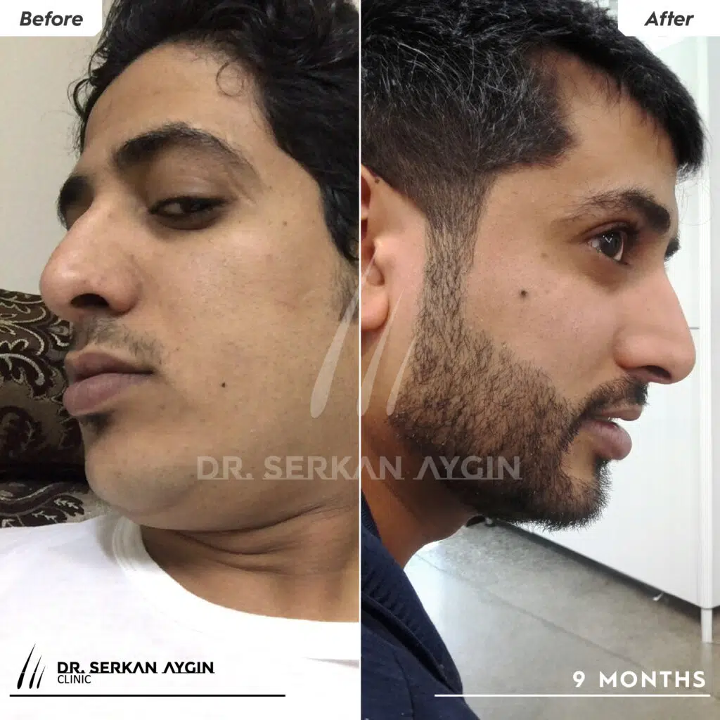 beard transplant before and after 2