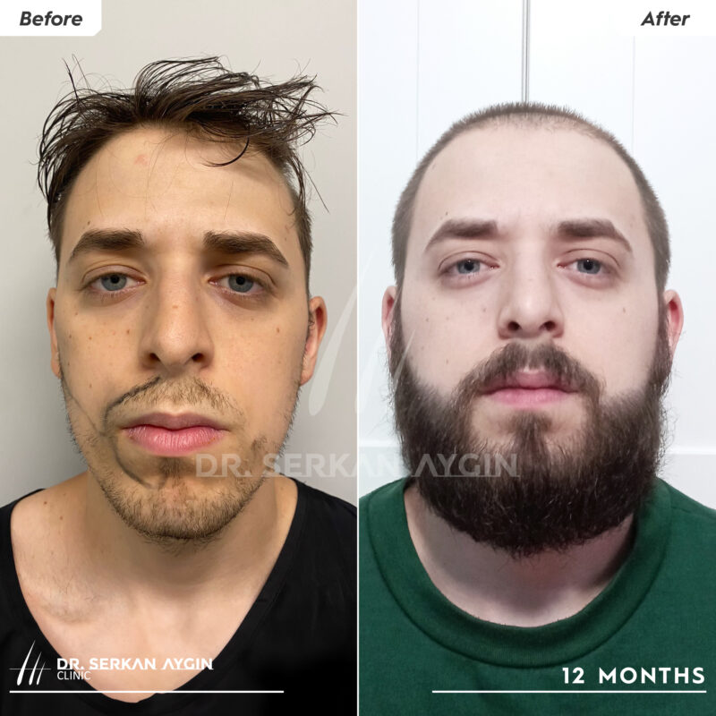 4,000+ grafts beard transplant turkey before and after results after 12 months